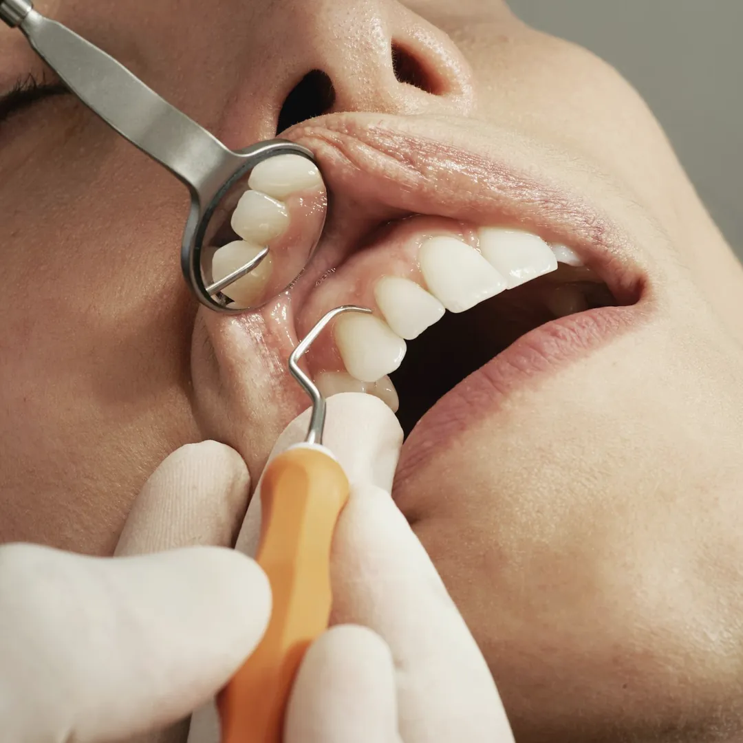 Revisión de encías con espejo y sonda dental.