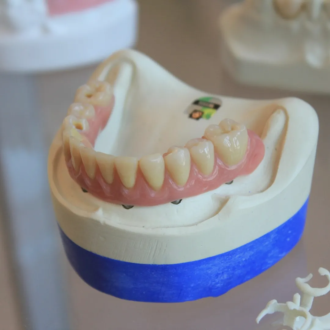 Prótesis dental sobre un modelo de yeso.