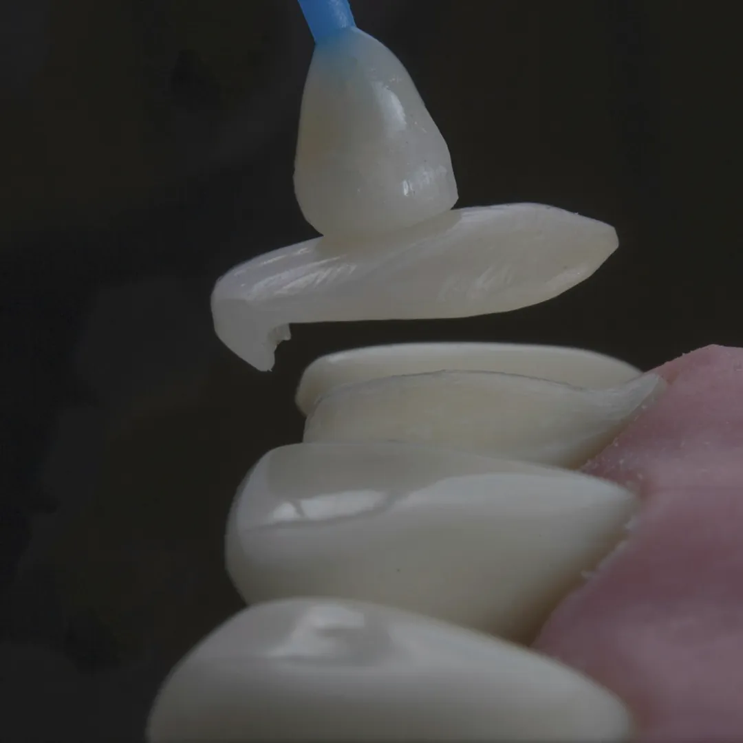 Carillas dentales sobre un modelo de dientes.